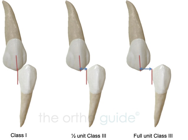 Class III – detailed – the ortho guide