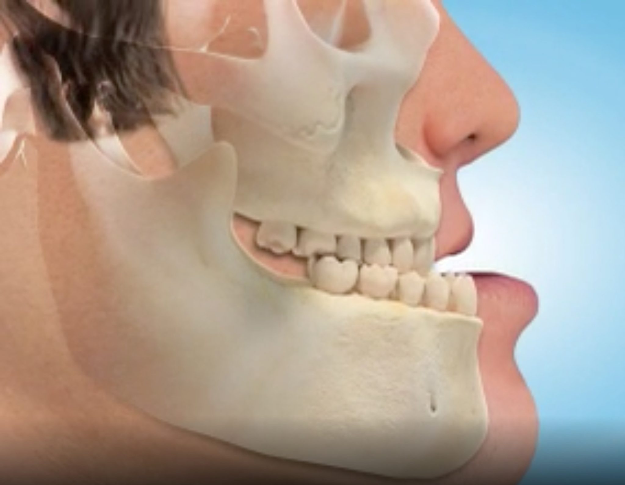 Posterior Crossbite Detailed Page 4 The Ortho Guide