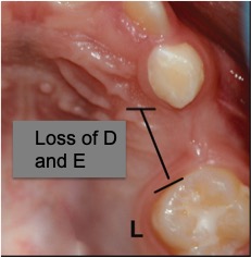 Early loss of deciduous teeth – the ortho guide